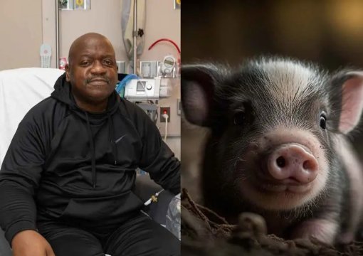 ¡Fue un éxito! Hombre que recibió riñón de cerdo genéticamente modificado sale del hospital